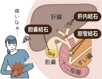2026年2月健康新聞～全身にできる結石～